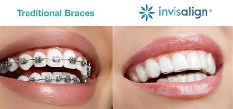 invisible braces metal brackets|clear braces pros and cons.